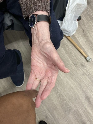 physiotherapists hand excerising patients fingers