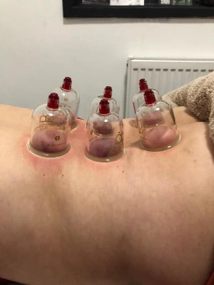 picture of cupping on mans back