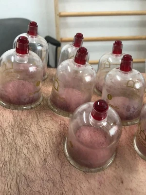 close up picture of cupping treatment on patients back