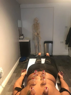 lady relaxing face down during cupping treatment